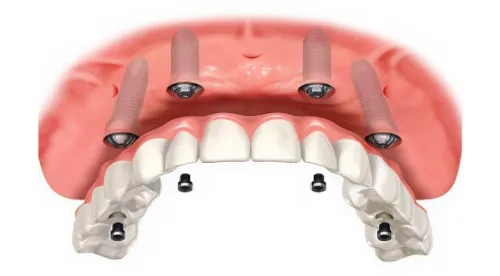 Prótese instalada em carga imediata sobre os implantes