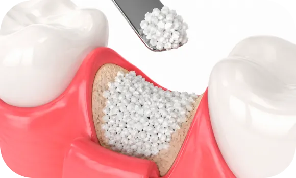 Corte clínico do biomaterial granulado preenchendo a falha óssea entre os dentes