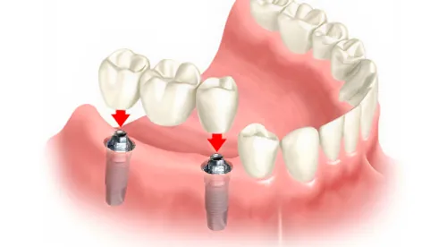 Prótese overdenture sobre os encaixes dos implantes