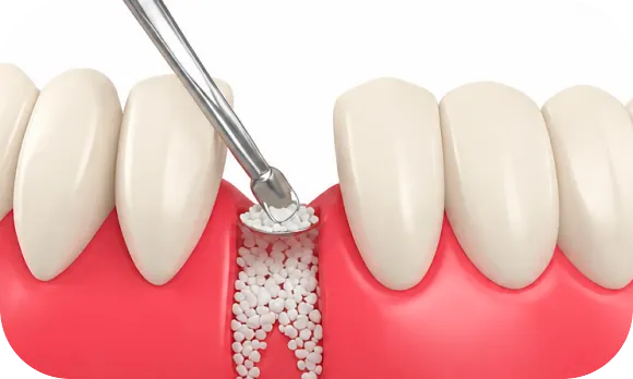 Corte clínico do enxerto ósseo sendo aplicado sobre a crista óssea, entre os dentes