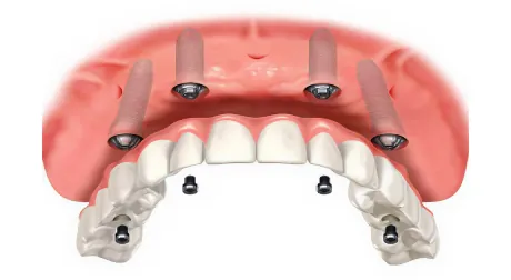 Prótese instalada em carga imediata sobre os implantes