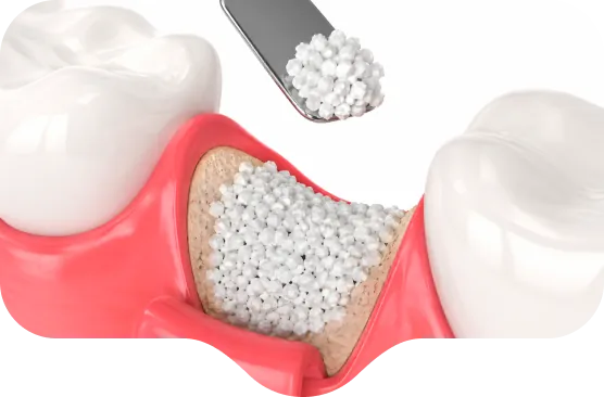 Ilustração de biomaterial sintético em grânulos preenchendo a falha óssea entre dois dentes