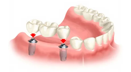 Prótese overdenture encaixando nos implantes por clipes