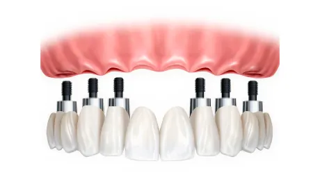 Prótese total fixa do tipo protocolo, aparafusada sobre implantes