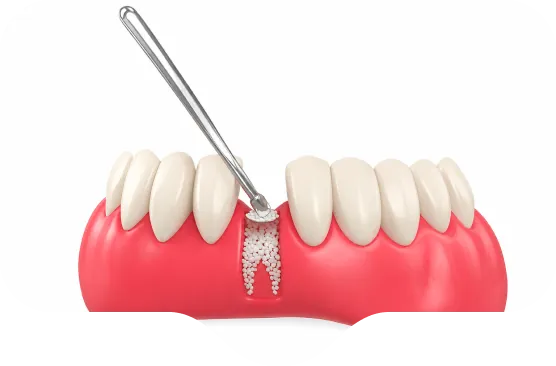 Ilustração de enxerto ósseo sendo aplicado no espaço de um dente perdido na arcada