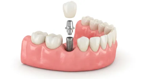 Coroa unitária sobre implante, reposição de um único dente